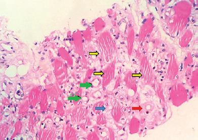 Section of the core biopsy from the quadriceps muscle showing the necrotic myofibres (yellow arrows) with intervening oedema (blue arrows), mononuclear cell infiltrate, prominent thin-walled capillaries (green arrows) with perivascular hyalinization (red arrow) and areas of fibrosis (H and E stain, ×400)